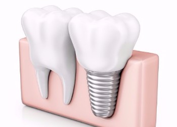 Dental Implants, Whitehorse Dentist