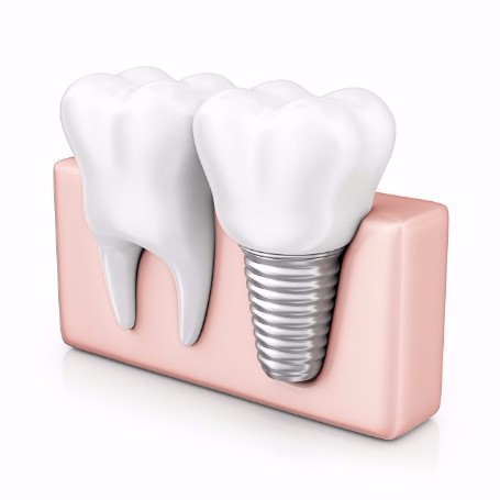 Dental Implants, Whitehorse Dentist